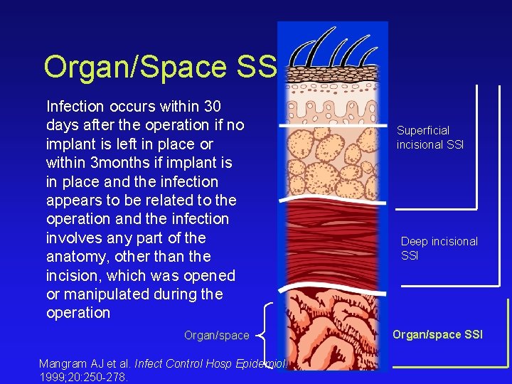 Organ/Space SSI Infection occurs within 30 days after the operation if no implant is