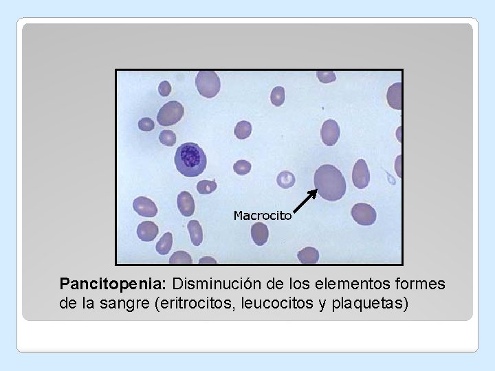 Macrocito Pancitopenia: Disminución de los elementos formes de la sangre (eritrocitos, leucocitos y plaquetas) Macrocito Pancitopenia: Disminución de los elementos formes de la sangre (eritrocitos, leucocitos y plaquetas)