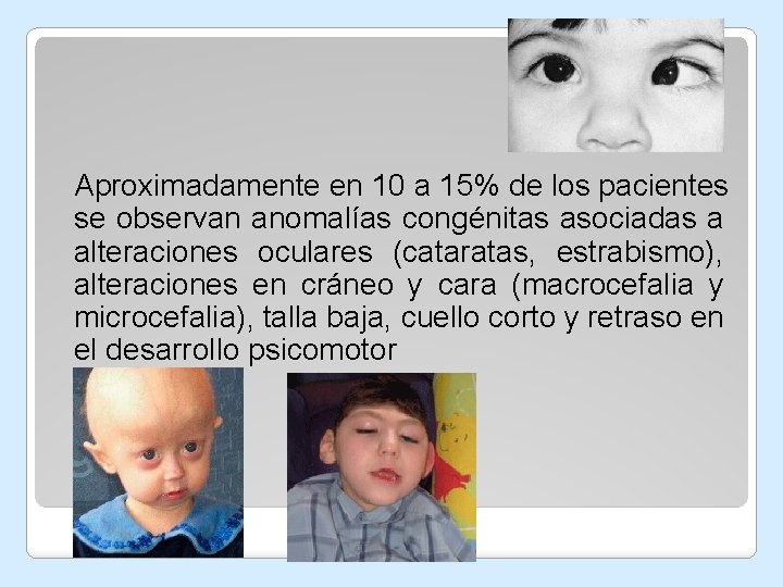 Aproximadamente en 10 a 15% de los pacientes se observan anomalías congénitas asociadas a Aproximadamente en 10 a 15% de los pacientes se observan anomalías congénitas asociadas a