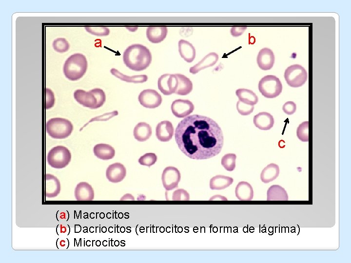 a b c (a) Macrocitos (b) Dacriocitos (eritrocitos en forma de lágrima) (c) Microcitos a b c (a) Macrocitos (b) Dacriocitos (eritrocitos en forma de lágrima) (c) Microcitos