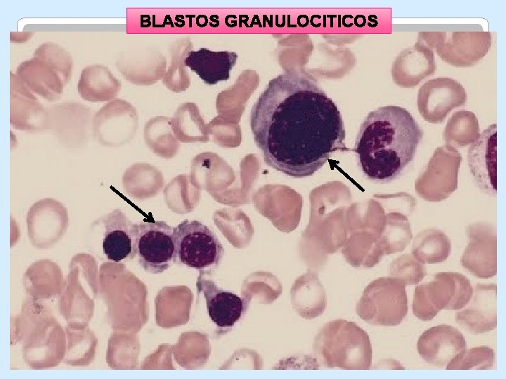 BLASTOS GRANULOCITICOS BLASTOS GRANULOCITICOS