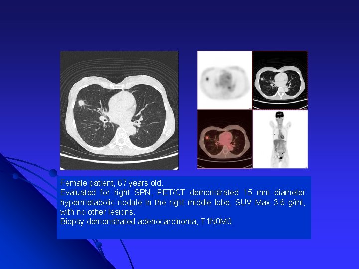 Female patient, 67 years old. Evaluated for right SPN, PET/CT demonstrated 15 mm diameter