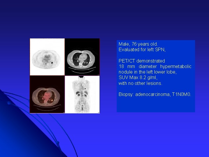 Male, 76 years old. Evaluated for left SPN, PET/CT demonstrated 18 mm diameter hypermetabolic