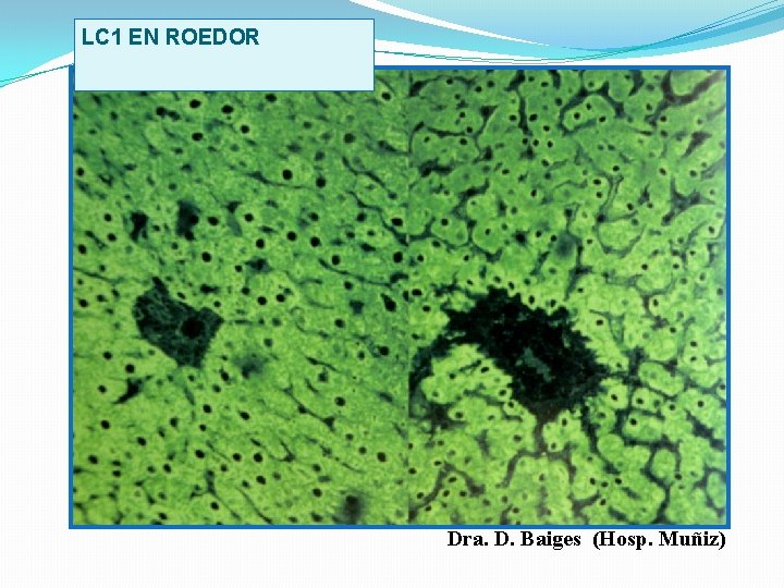 LC 1 EN ROEDOR Dra. D. Baiges (Hosp. Muñiz) 