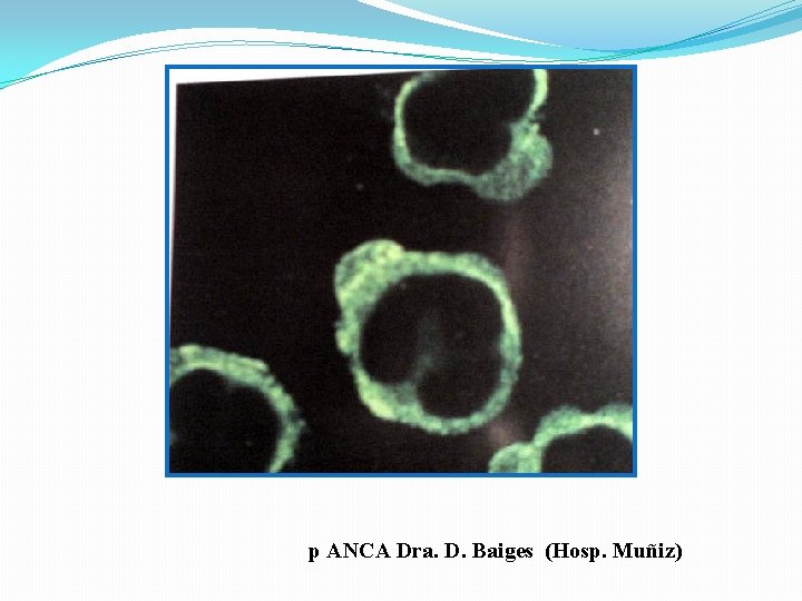 p ANCA Dra. D. Baiges (Hosp. Muñiz) 