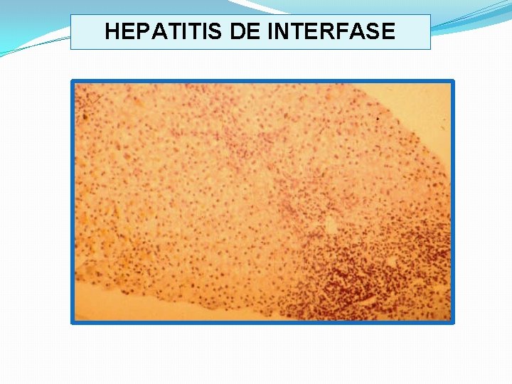 HEPATITIS DE INTERFASE 