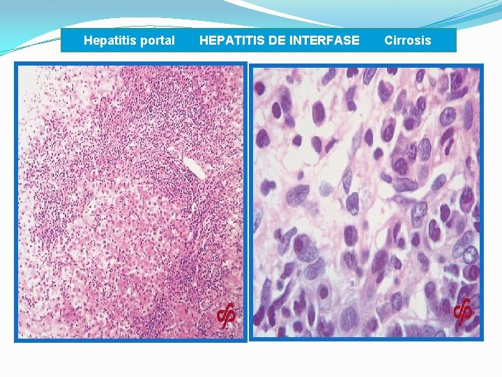  Hepatitis portal HEPATITIS DE INTERFASE Cirrosis 