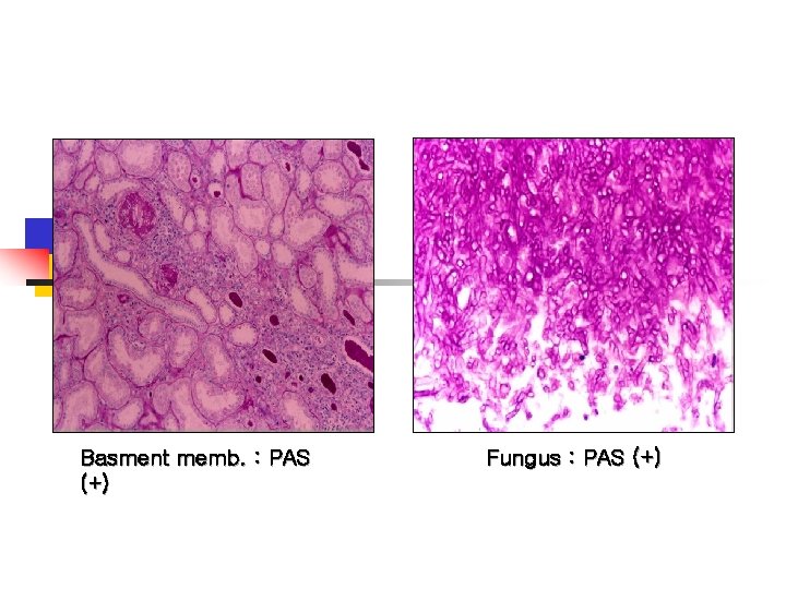  Basment memb. : PAS (+) Fungus : PAS (+) 