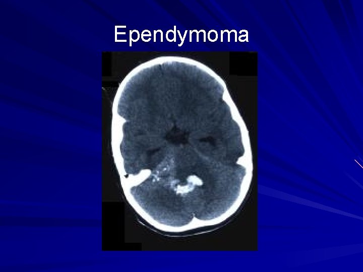 Ependymoma 