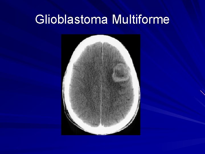 Glioblastoma Multiforme 