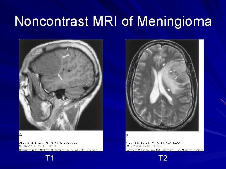 Noncontrast MRI of Meningioma T 1 T 2 