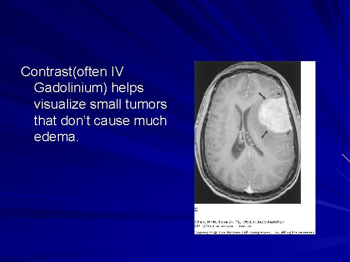 Contrast(often IV Gadolinium) helps visualize small tumors that don’t cause much edema. 