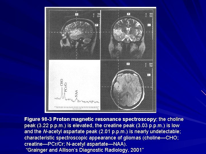 Figure 98 -3 Proton magnetic resonance spectroscopy; the choline peak (3. 22 p. p.