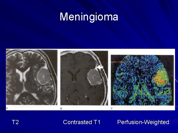 Meningioma T 2 Contrasted T 1 Perfusion-Weighted 