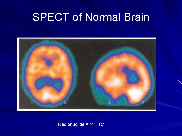 SPECT of Normal Brain Radionuclide = 99 m TC 