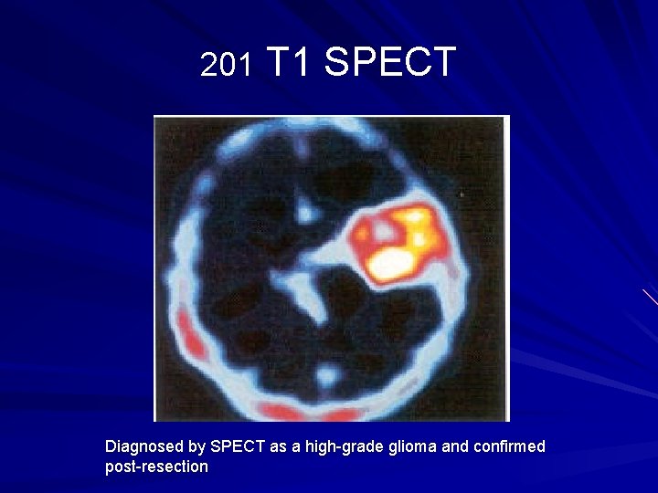 201 T 1 SPECT Diagnosed by SPECT as a high-grade glioma and confirmed post-resection