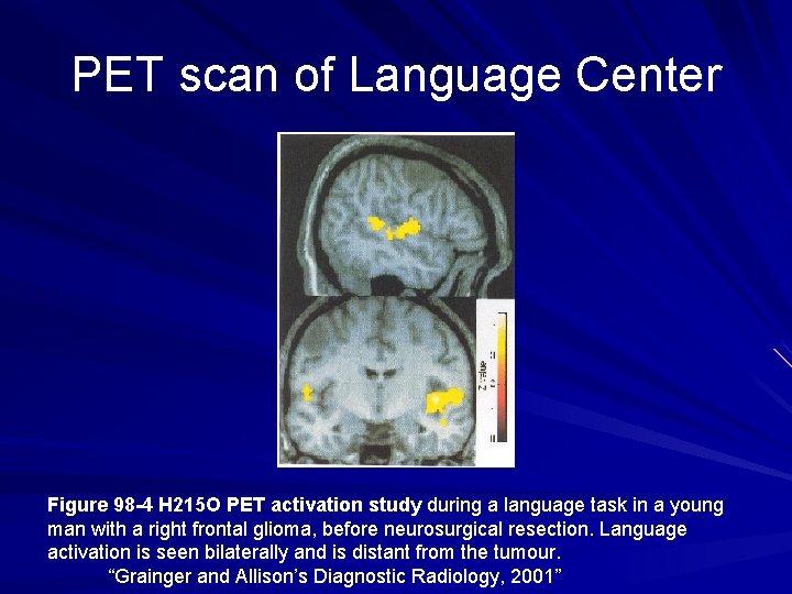 PET scan of Language Center Figure 98 -4 H 215 O PET activation study