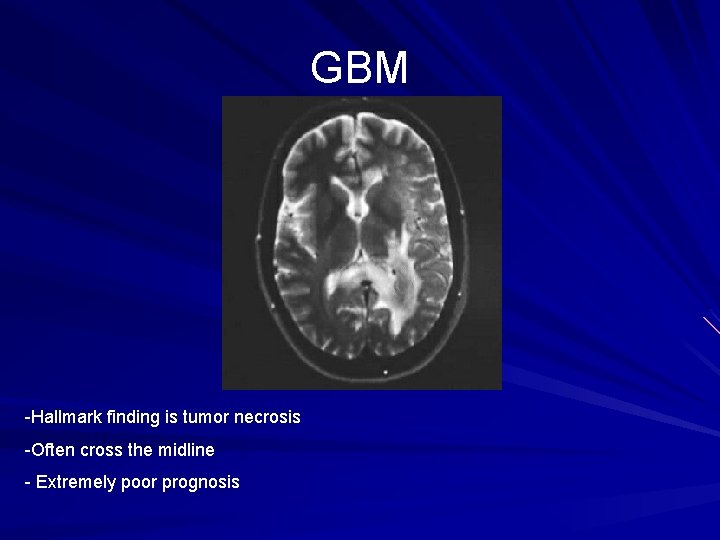 GBM -Hallmark finding is tumor necrosis -Often cross the midline - Extremely poor prognosis