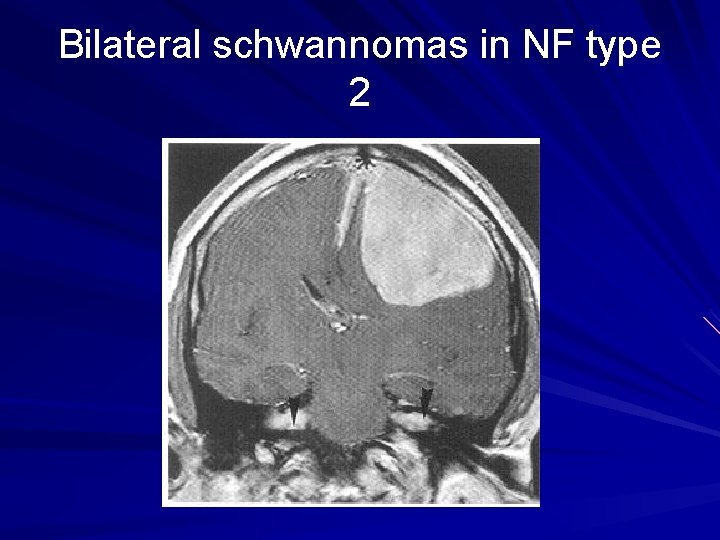 Bilateral schwannomas in NF type 2 