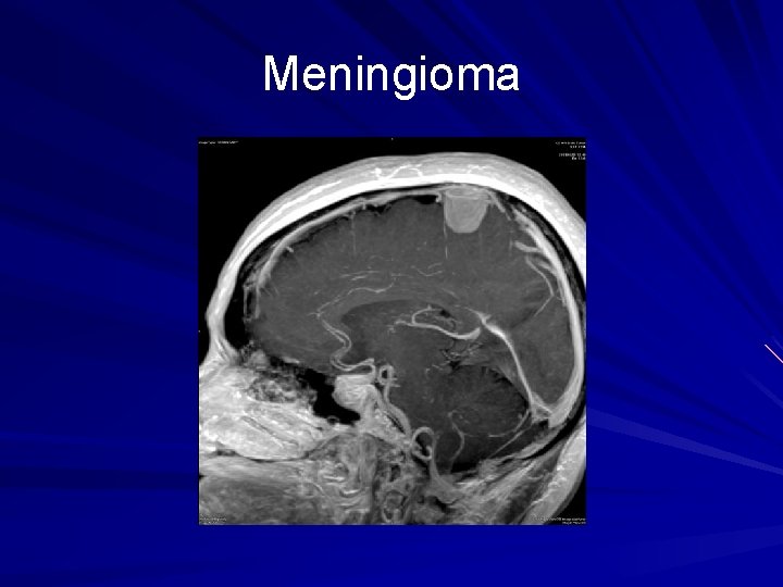 Meningioma 