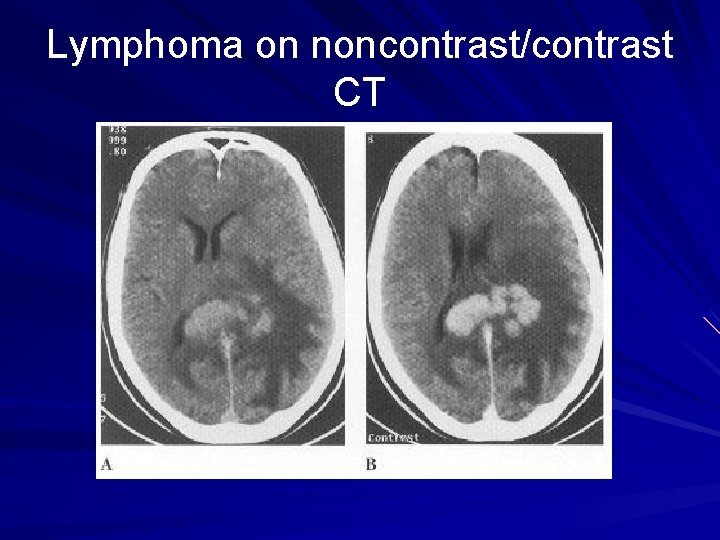 Lymphoma on noncontrast/contrast CT 