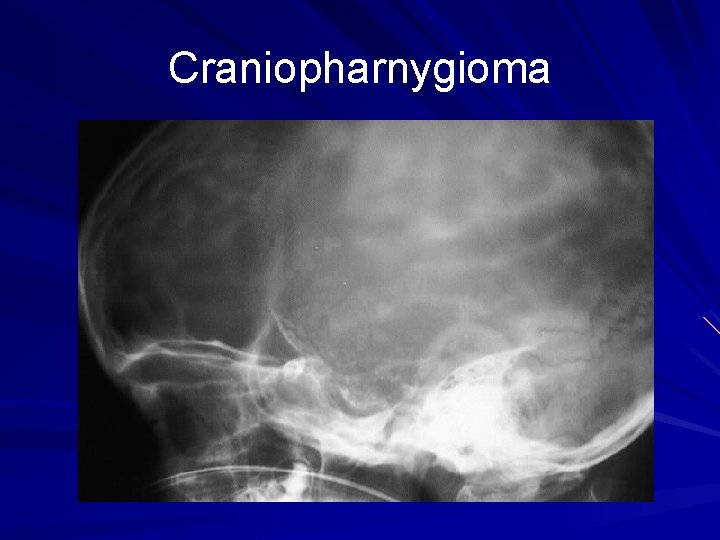 Craniopharnygioma 