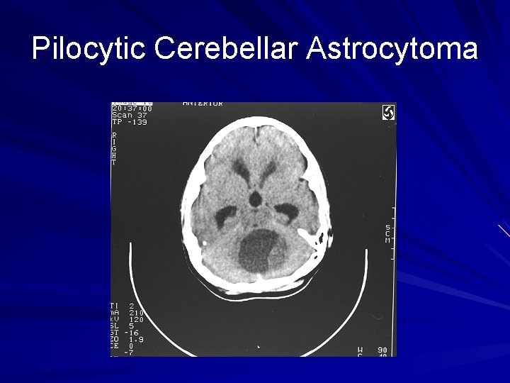 Pilocytic Cerebellar Astrocytoma 