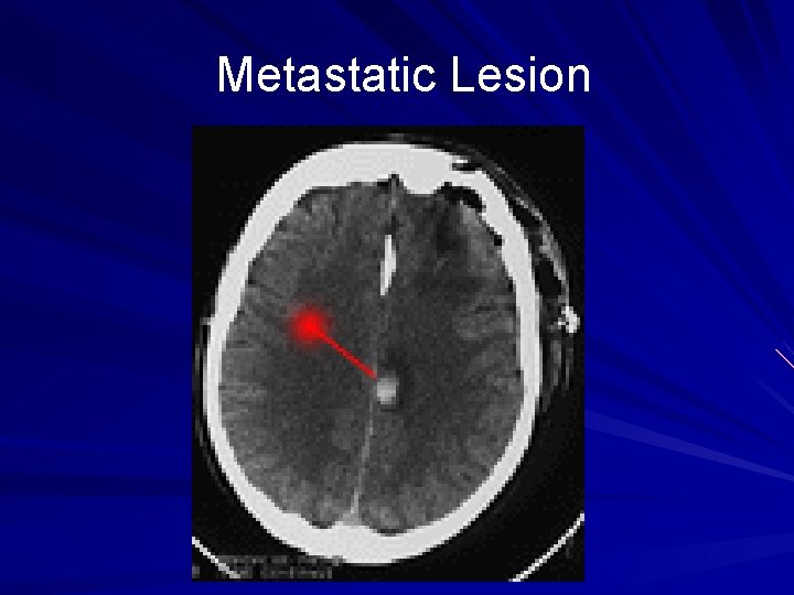 Metastatic Lesion 