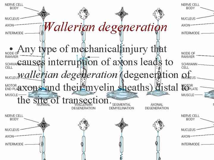Wallerian degeneration • Any type of mechanical injury that causes interruption of axons leads