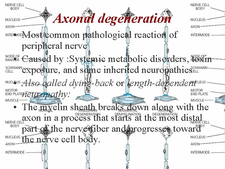 Axonal degeneration • Most common pathological reaction of peripheral nerve • Caused by :