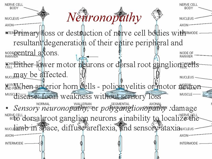 Neuronopathy • Primary loss or destruction of nerve cell bodies with resultant degeneration of