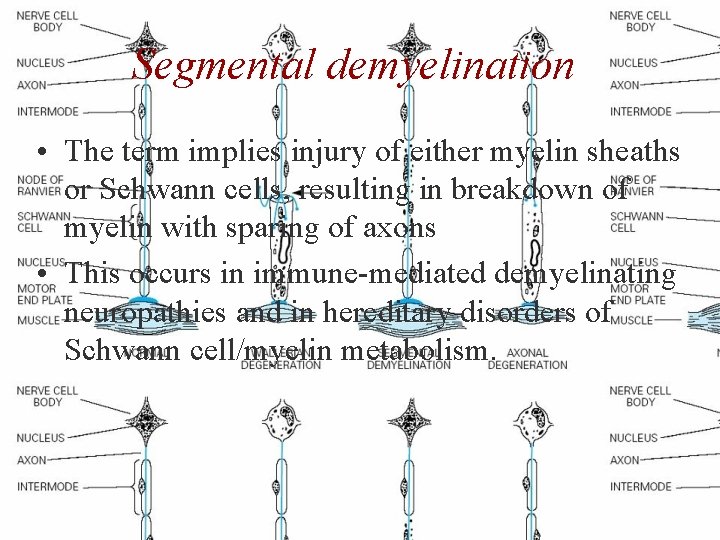 Segmental demyelination • The term implies injury of either myelin sheaths or Schwann cells,