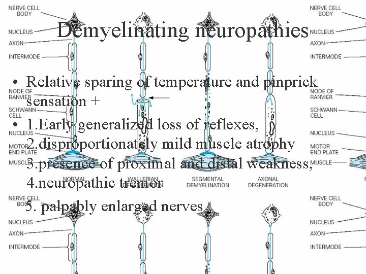 Demyelinating neuropathies • Relative sparing of temperature and pinprick sensation + • 1. Early