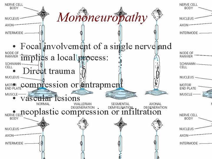 Mononeuropathy • Focal involvement of a single nerve and implies a local process: •