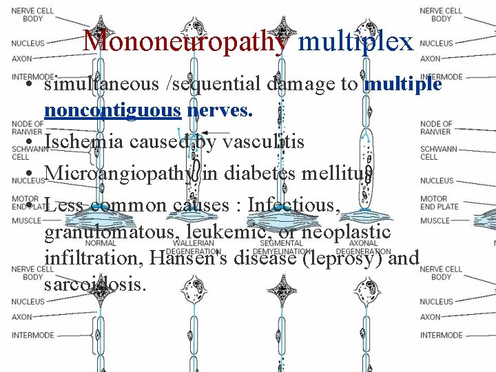 Mononeuropathy multiplex • simultaneous /sequential damage to multiple noncontiguous nerves. • Ischemia caused by