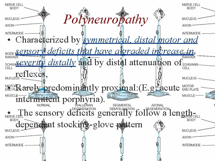Polyneuropathy • Characterized by symmetrical, distal motor and sensory deficits that have a graded