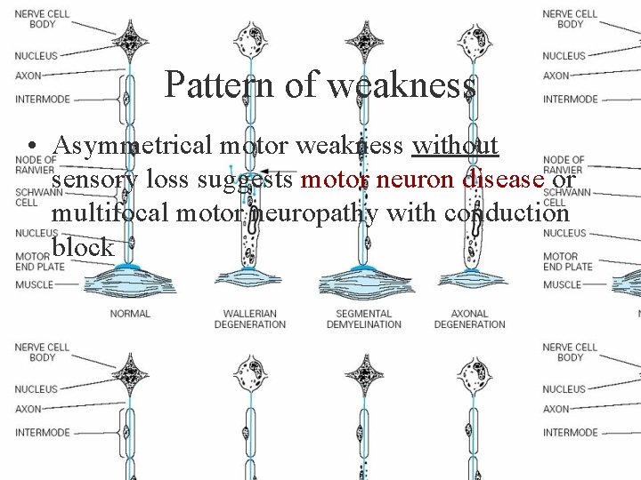 Pattern of weakness • Asymmetrical motor weakness without sensory loss suggests motor neuron disease