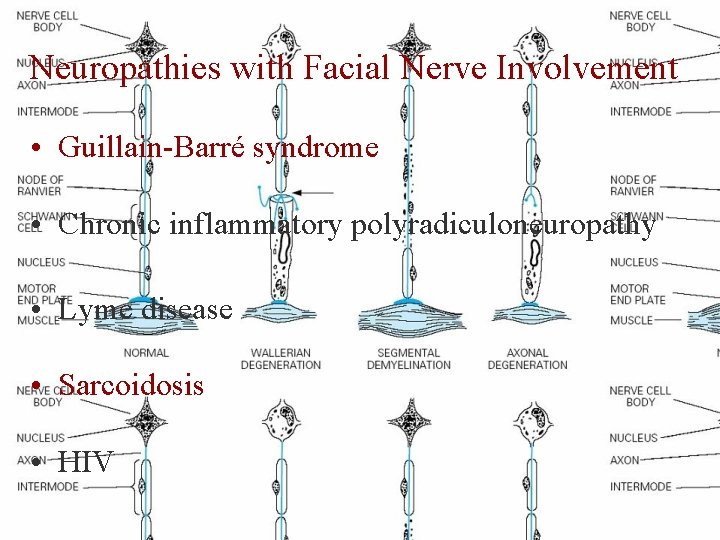 Neuropathies with Facial Nerve Involvement • Guillain-Barré syndrome • Chronic inflammatory polyradiculoneuropathy • Lyme