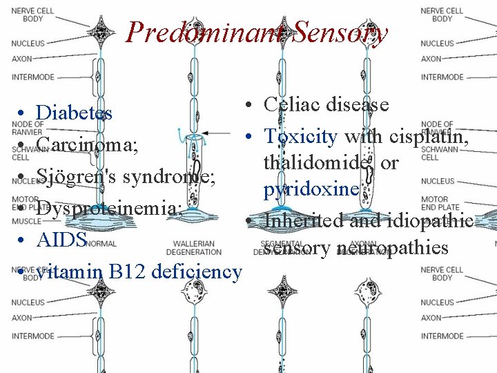 Predominant Sensory • • Diabetes • Carcinoma; Sjögren's syndrome; Dysproteinemia; • AIDS vitamin B