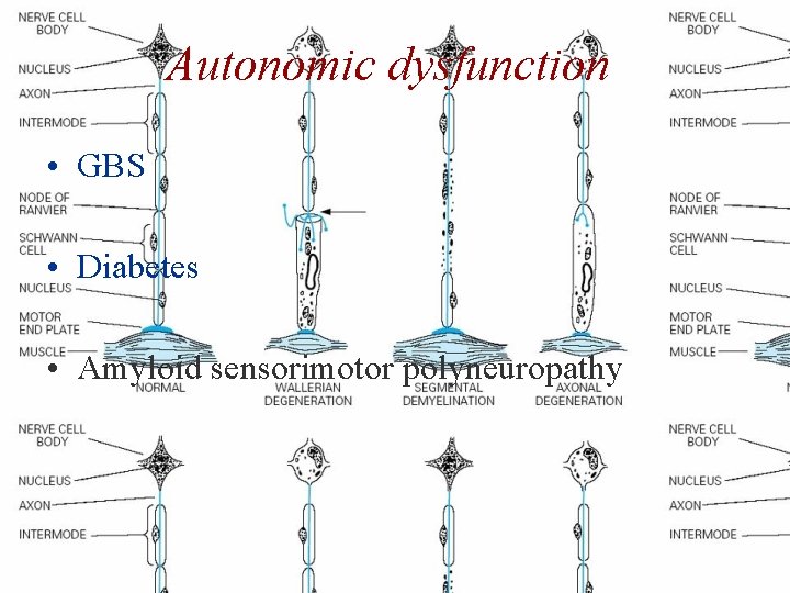 Autonomic dysfunction • GBS • Diabetes • Amyloid sensorimotor polyneuropathy 