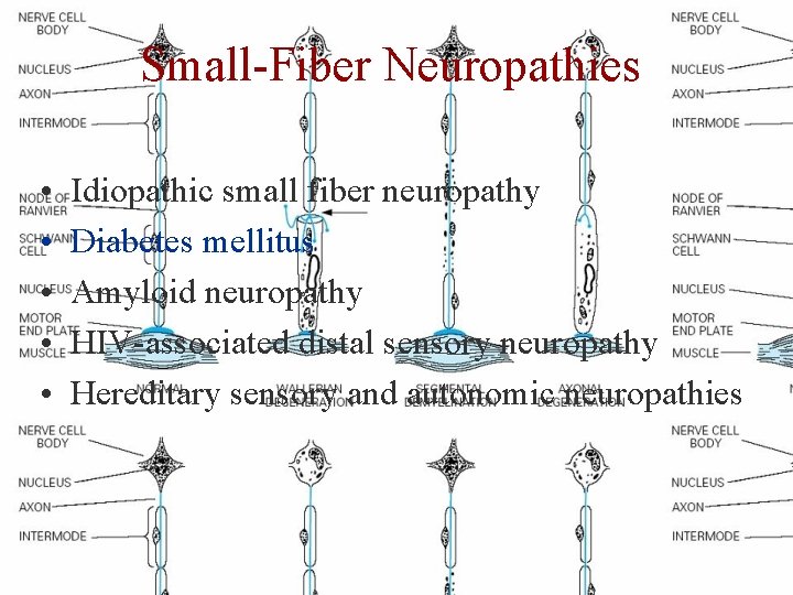 Small-Fiber Neuropathies • • • Idiopathic small fiber neuropathy Diabetes mellitus Amyloid neuropathy HIV-associated