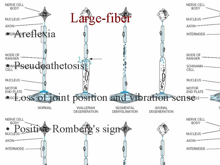 Large-fiber • Areflexia • Pseudoathetosis • Loss of joint position and vibration sense •
