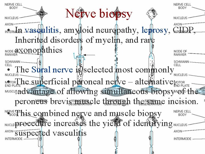 Nerve biopsy • In vasculitis, amyloid neuropathy, leprosy, CIDP, Inherited disorders of myelin, and