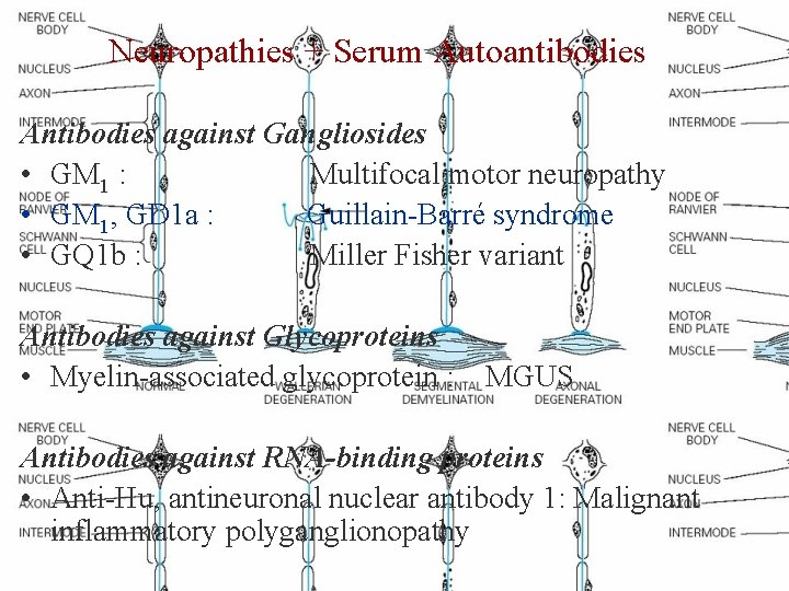 Neuropathies + Serum Autoantibodies Antibodies against Gangliosides • GM 1 : Multifocal motor neuropathy