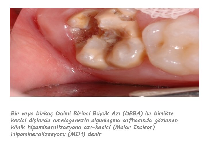 GİRİŞ Bir veya birkaç Daimi Birinci Büyük Azı (DBBA) ile birlikte kesici dişlerde amelogenezin