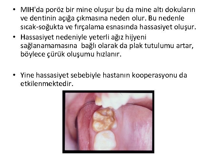  • MIH'da poröz bir mine oluşur bu da mine altı dokuların ve dentinin