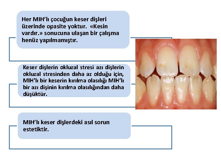 Her MIH’lı çocuğun keser dişleri üzerinde opasite yoktur. «Kesin vardır. » sonucuna ulaşan bir