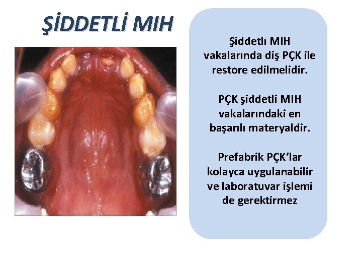 ŞİDDETLİ MIH Şiddetlı MIH vakalarında diş PÇK ile restore edilmelidir. PÇK şiddetli MIH vakalarındaki