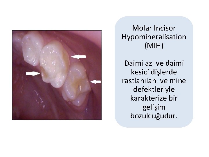 Molar Incisor Hypomineralisation (MIH) Daimi azı ve daimi kesici dişlerde rastlanılan ve mine defektleriyle