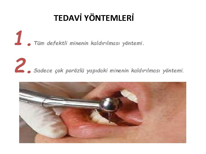 TEDAVİ YÖNTEMLERİ 1. 2. Tüm defektli minenin kaldırılması yöntemi. Sadece çok porözlü yapıdaki minenin